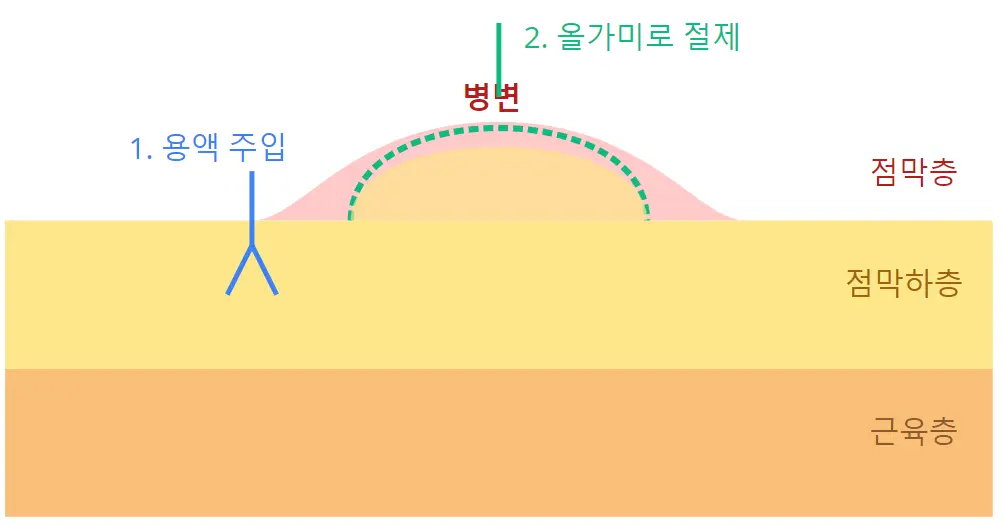 EMR (내시경 점막 절제술)