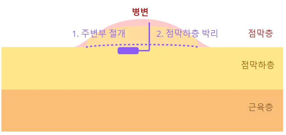 ESD (내시경 점막하 박리술)